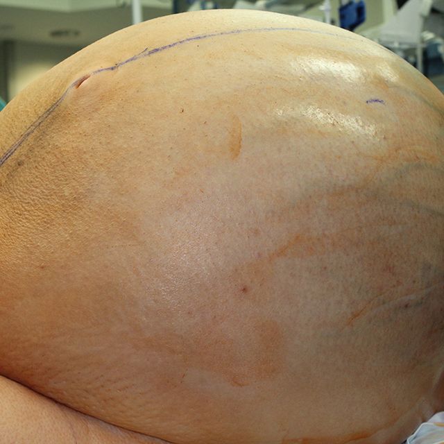 132 pound ovarian tumor