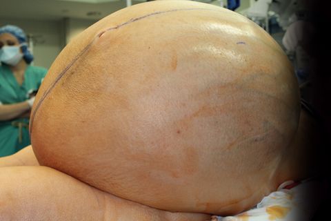 132 pound ovarian tumor before removal 