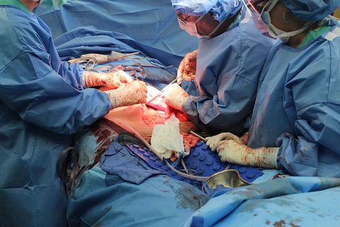 132 pound ovarian tumor removal surgery 