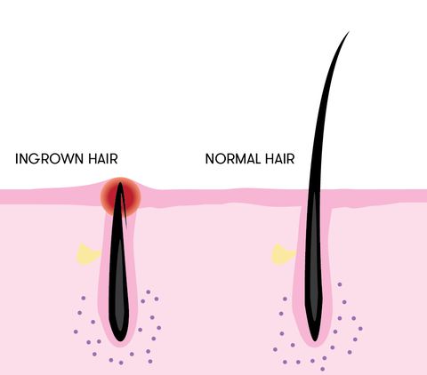 ingrown hair cyst on vag lips treatment - Lashon Shipman