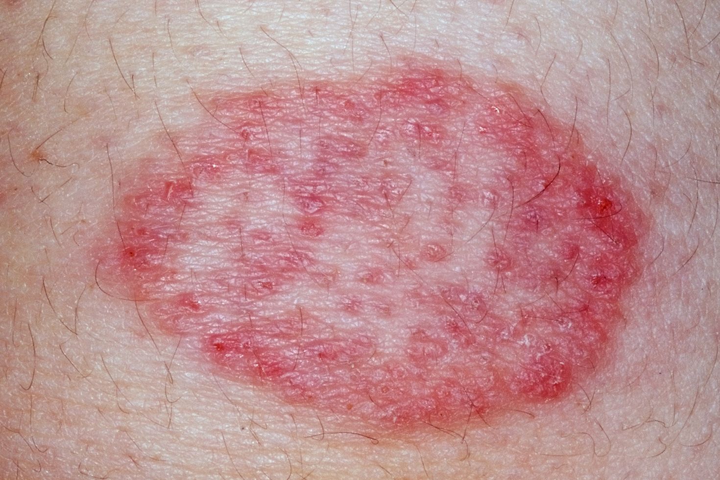 13 Common Causes Of Butt Rashes And Bumps, According To MDs