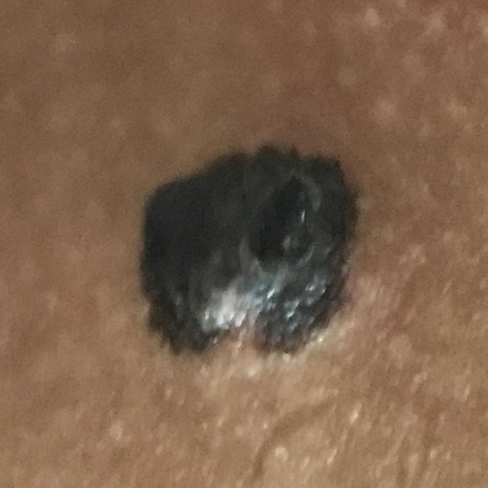 smith's cancerous mole
