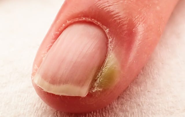 7 Gross Things That Happen When You Bite Your Nails Prevention 