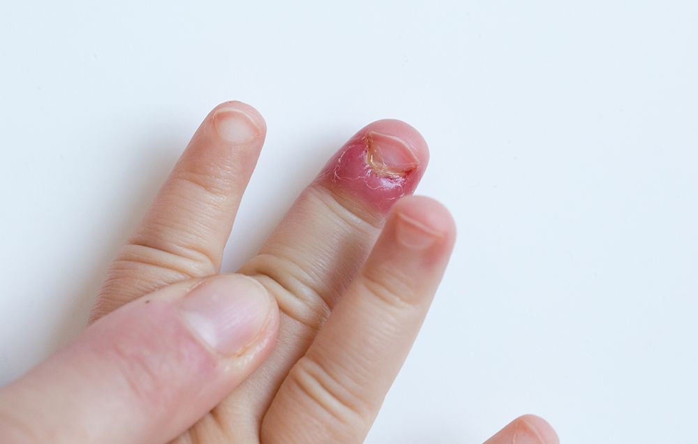 Moms Warning About Nail Biting Goes Viral  Facebook Post Shows Why Kids  Shouldnt Bite Their Nails