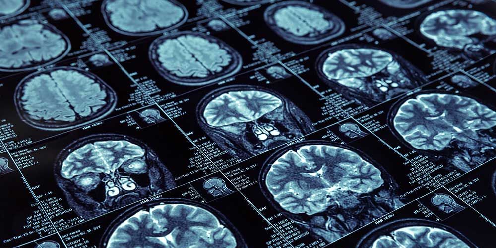 A Diabetes Drug Could Protect Against Alzheimer’s Disease, New Research Suggests
