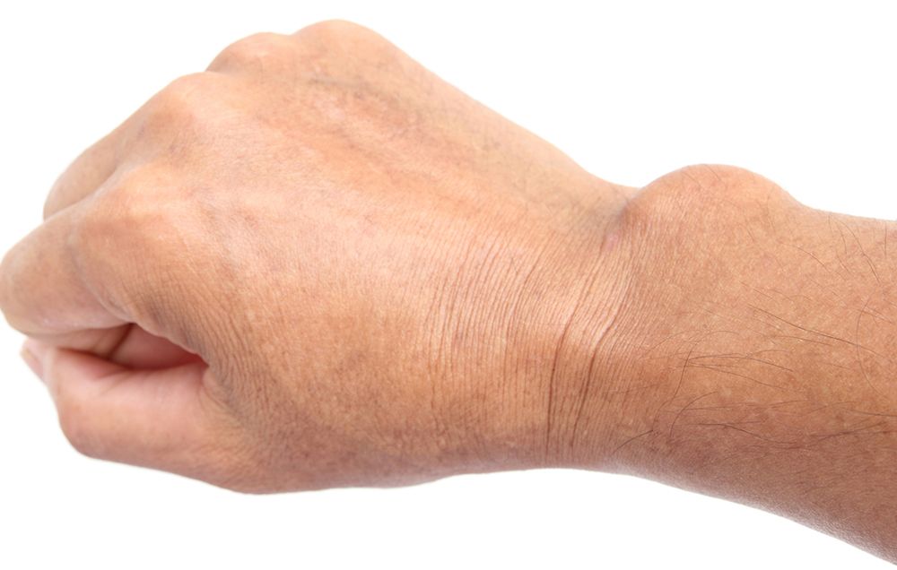 Cysts