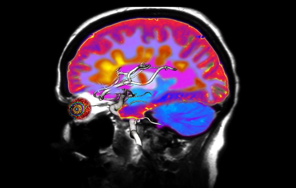 multiple sclerosis