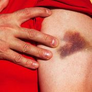 reasons you bruise easily