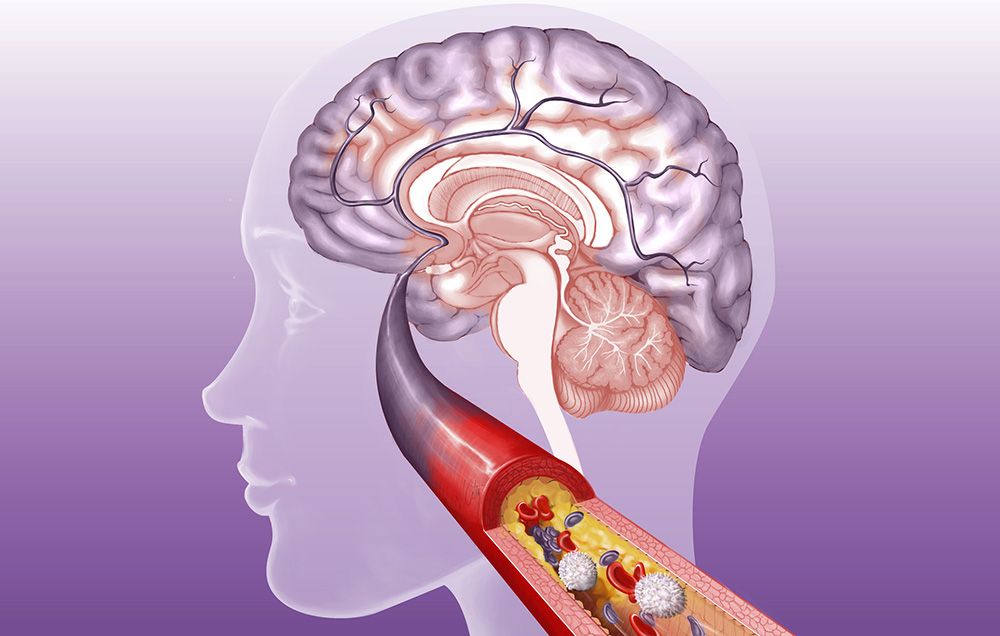 stroke