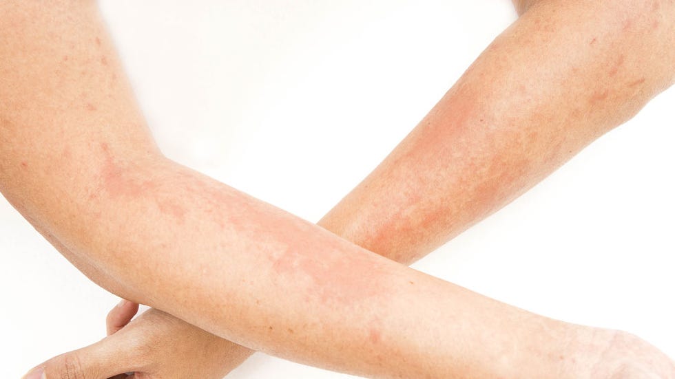 hives on arms