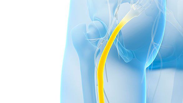 Get Rid of Sciatica Pain Without Surgery