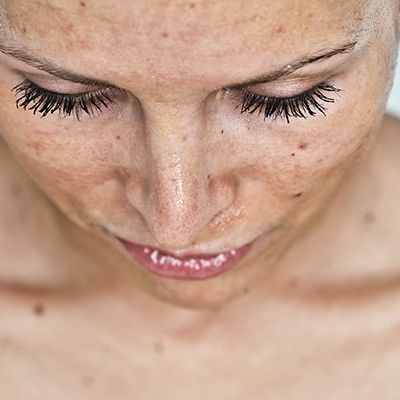 New Beauty Treatment For Sun Damaged Skin