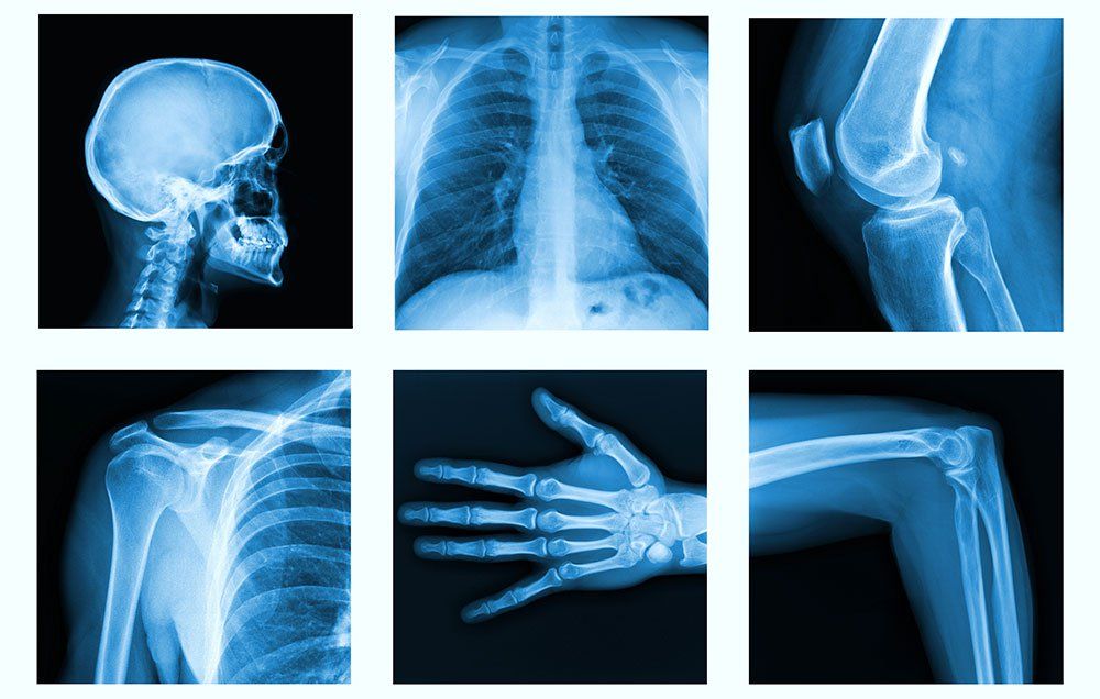 What To Eat For Stronger Bones