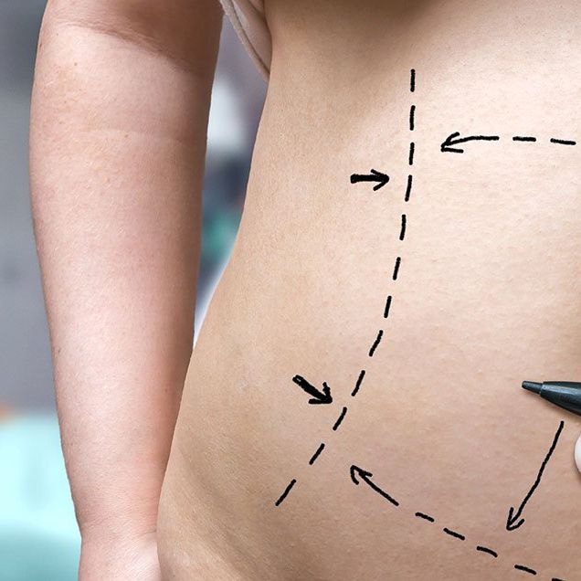will insurance cover tummy tuck after bariatric surgery