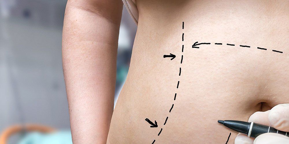 How Fashion Affects Abdominoplasty Scar Placement