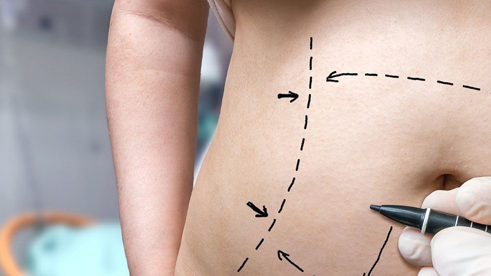 What You Need to Know About Tummy Tuck Scarring