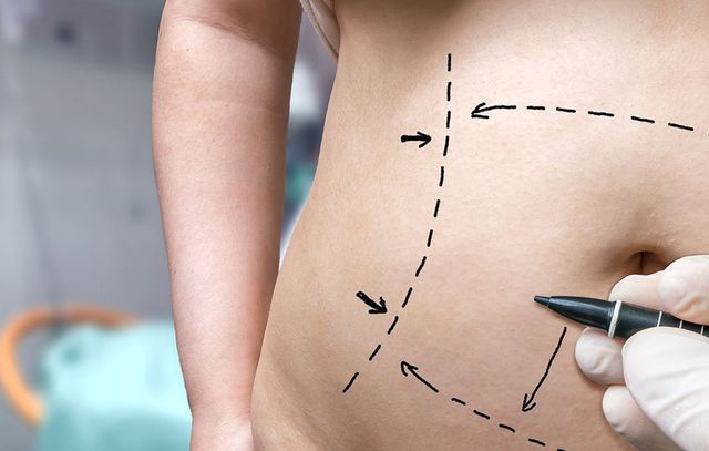 8 Things You Should Know About A Tummy Tuck—From Someone Who Got One
