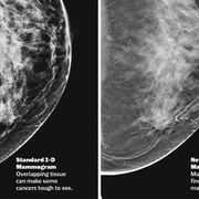 mammogram technology