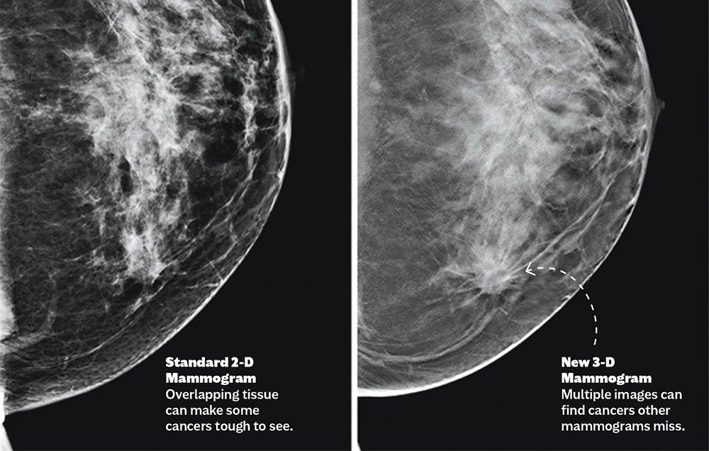 mammogram technology