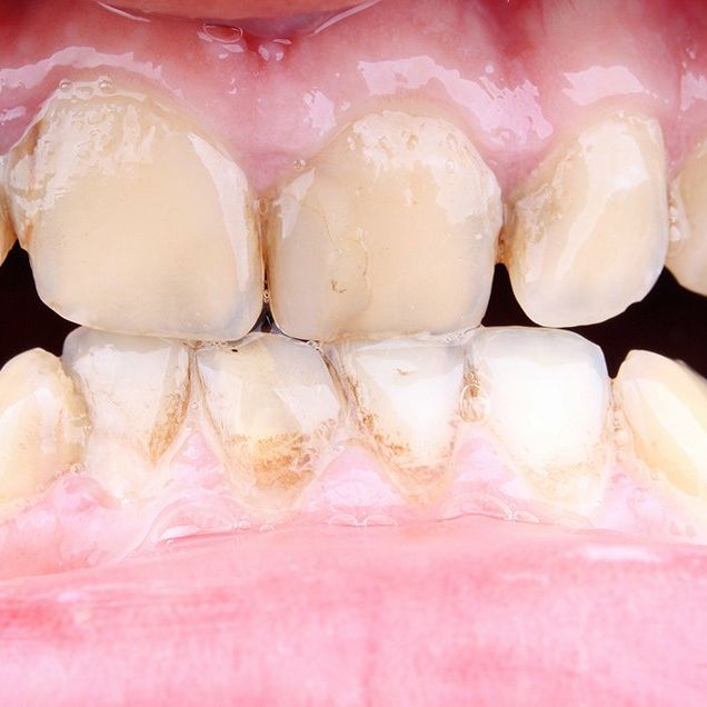 problem solved: gum disease