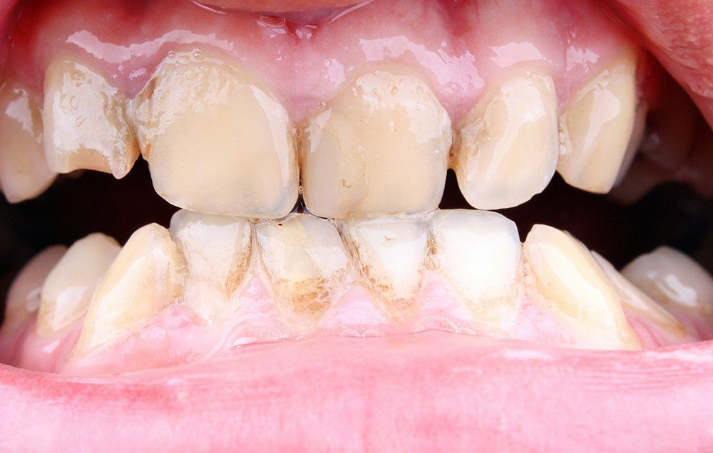 problem solved: gum disease