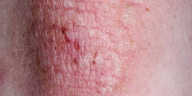 eczema and your health