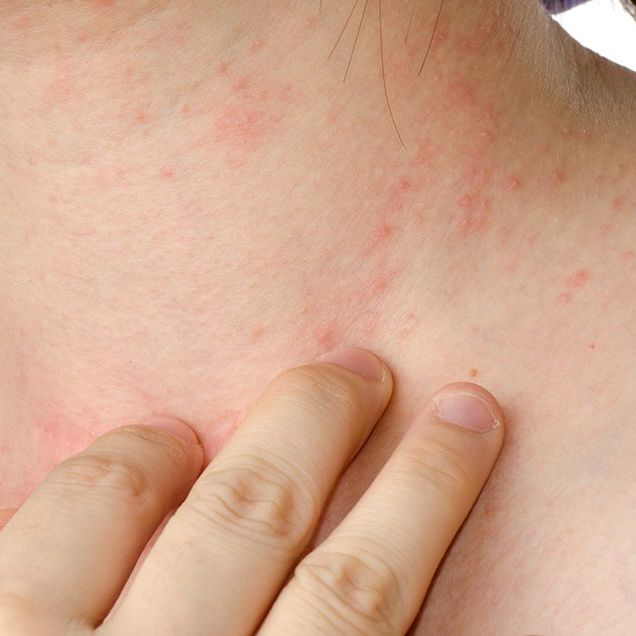 7 Best Natural Remedies For Eczema