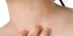 eczema natural remedies
