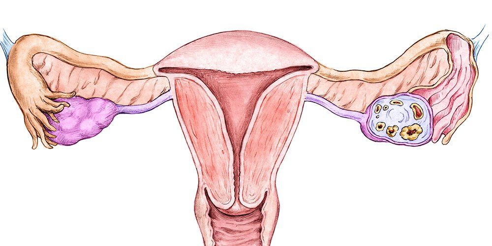 5 Warning Signs Of Endometrial Cancer Every Woman Should Know