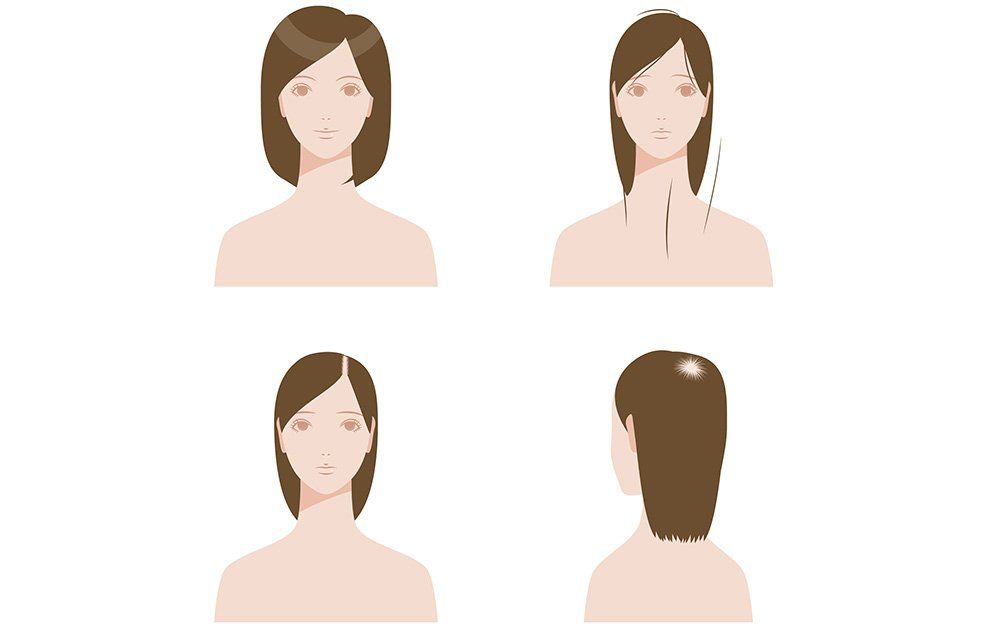 6 Women Reveal The Hair Loss 