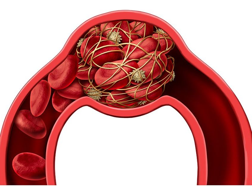 These 8 Groups Of People Are More Prone To Blood Clots