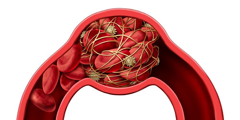 Types and causes of blood clots