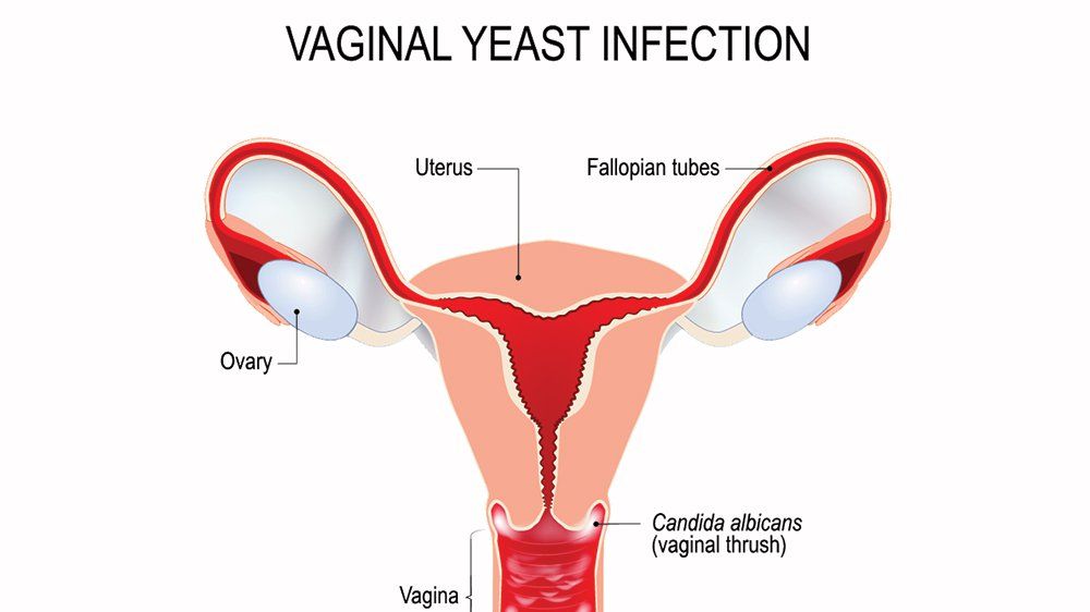 What are the symptoms of yeast infection in females? - Quora