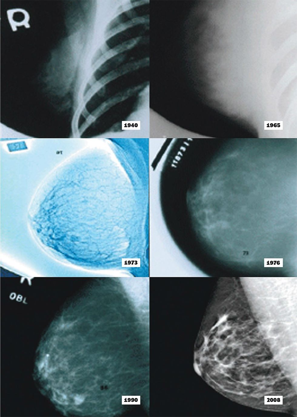mammogram changes over years