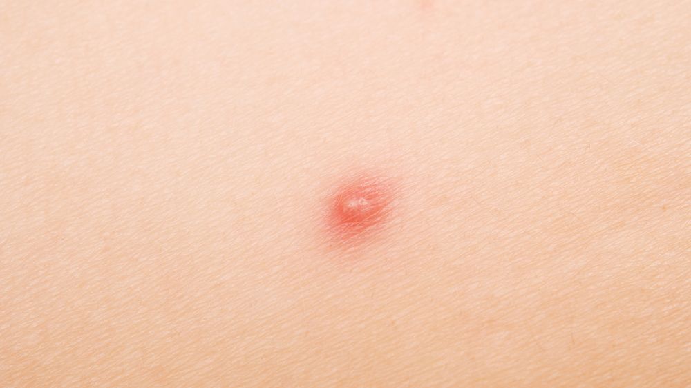 Yes, That's Acne On Your Vagina. Here's How To Treat It. | Prevention