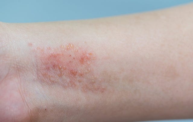 Ease Your Itchy Skin With These 8 Best Eczema Treatments | Prevention