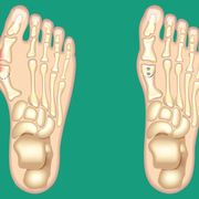 Bunion pain and surgery