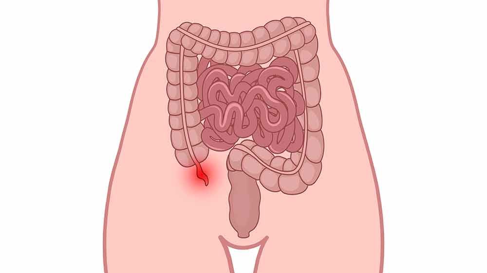 5 Appendicitis Symptoms and Warning Signs - Signs of Appendicitis
