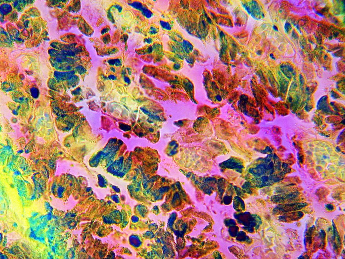 Maligne melanoom roze is bij mensen een van de meest gevreesde soorten kanker Melanoom zaait snel uit en kan vanuit zijn oorsprong vrijwel alle organen binnendringen waaronder de longen op de foto De kleuren in deze foto weerspiegelen niet de echte pigmenten van de cellen