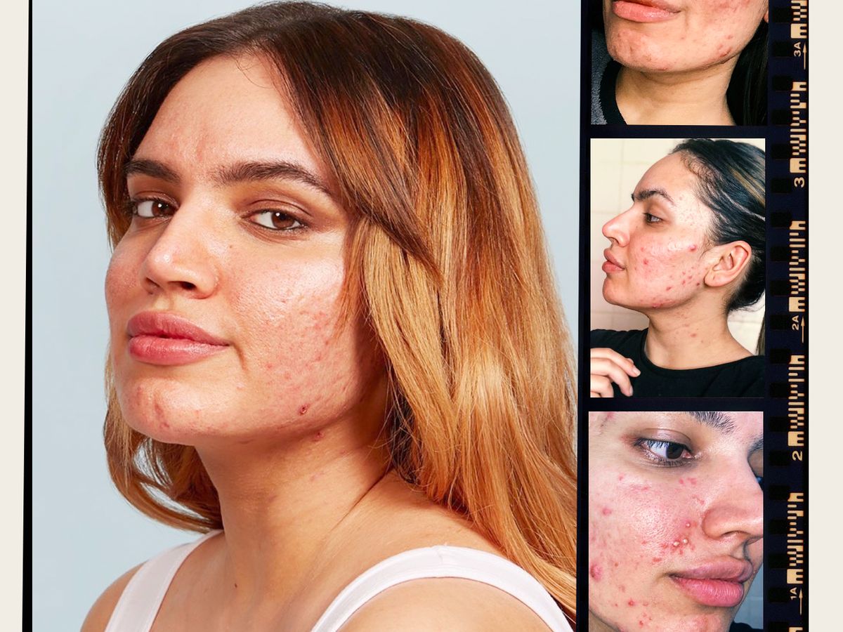 Teen Shares Viral Acne Message on Instagram