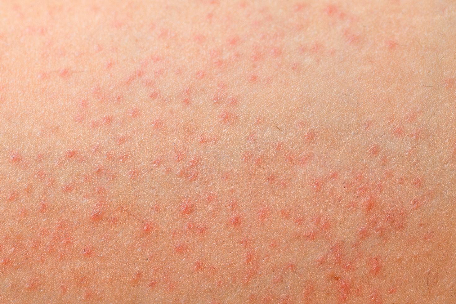 Risikabel Lys kode 13 Common Causes Of Butt Rashes And Bumps, According To MDs