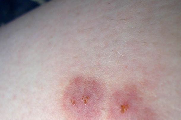 Spider Bite Pictures - What Do Spider Bites Look Like?