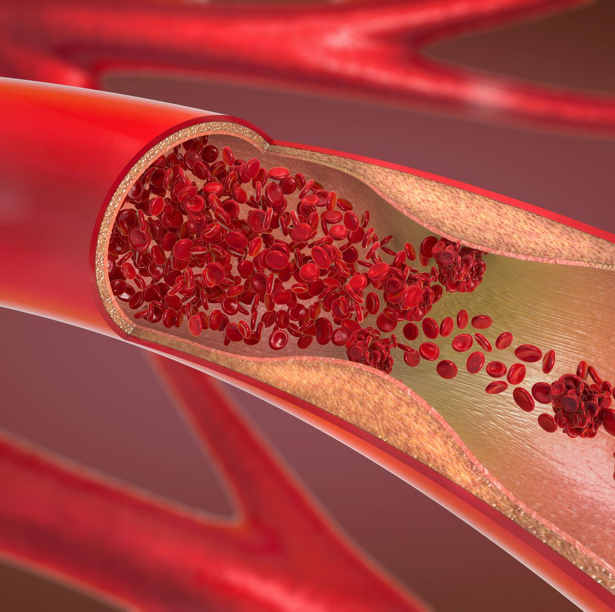 8 Signs of a Blood Clot - Symptoms in Legs, Chest, Neck, and More