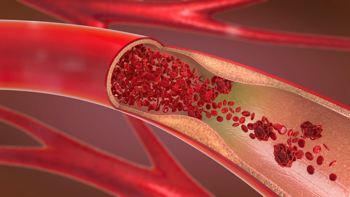 Cavitation energy breaks the blood clot into small pieces in an