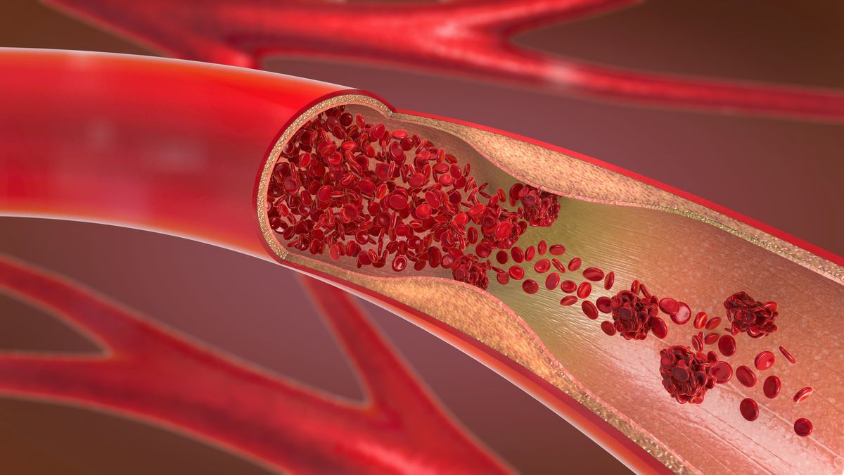 8 Signs of a Blood Clot - Symptoms in Legs, Chest, Neck, and More