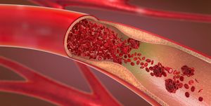 3d illustration of a constricted and narrowed artery and the blood cannot flow properly called arteriosclerosis