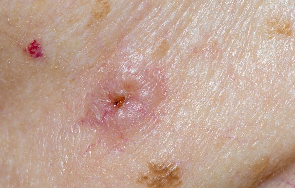 Skin Bumps That Look Like Pimples but Aren't