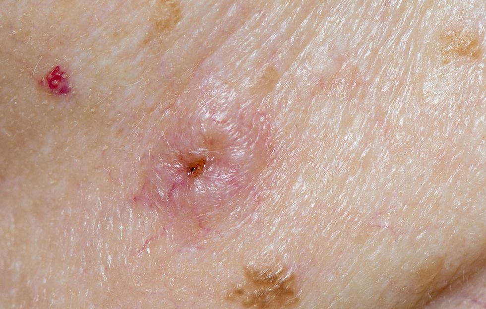 Why do I feel a lump under my armpit which is infected? - Quora