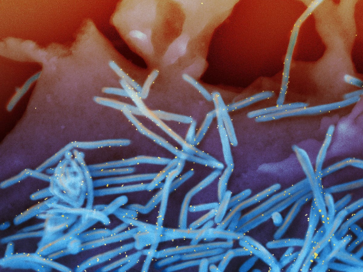 Een elektronenmicroscopische afbeelding van het respiratoir syncytieel virus RSV De virusdeeltjes blauw zijn gebonden aan met goud gelabelde antiRSVFeiwitantilichamen geel die van het oppervlak van menselijke longcellen afkomen Het aantal gevallen van RSV neemt dit jaar ongebruikelijk vroeg toe