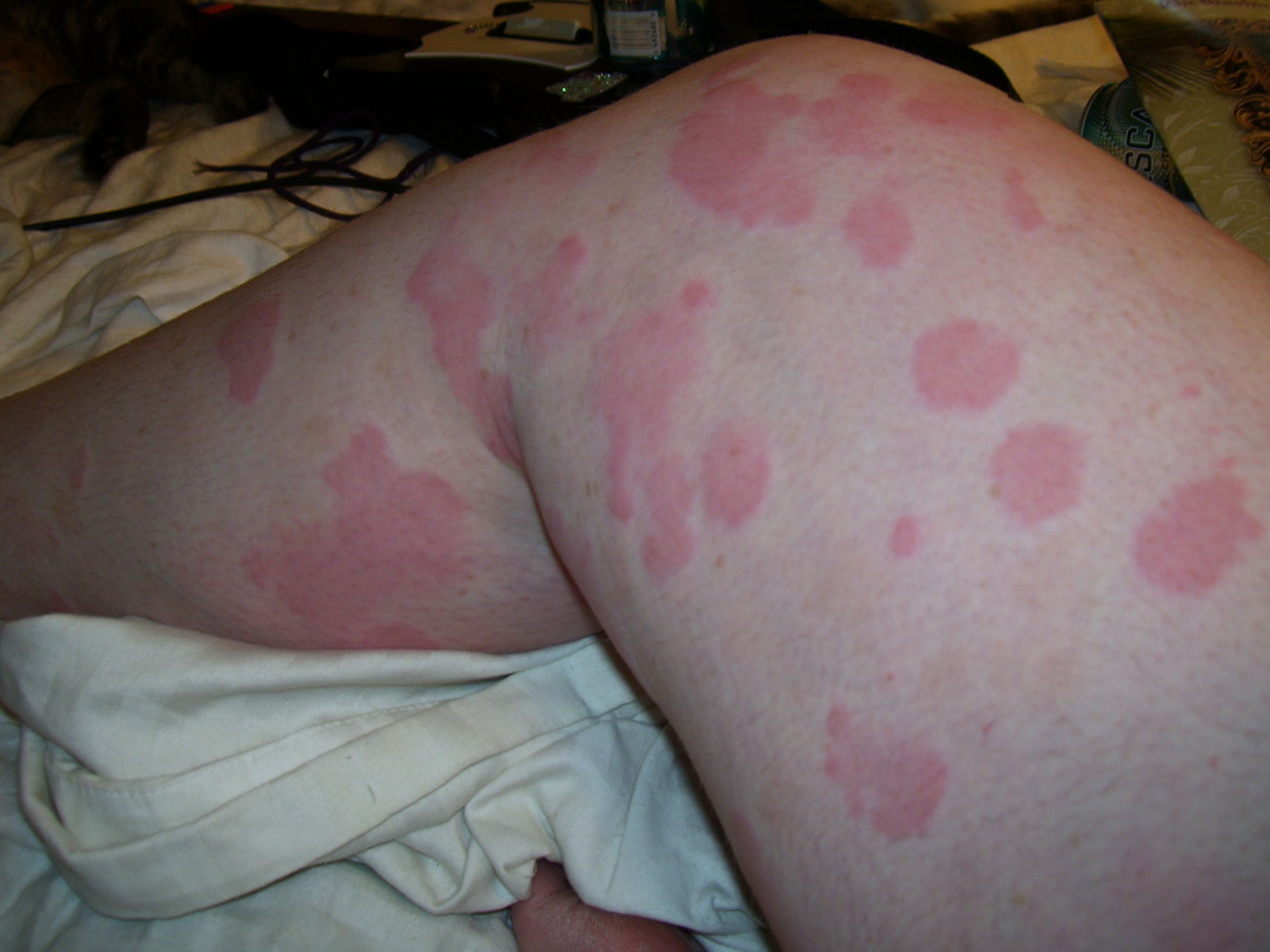 Woman Body Skin with Red Allergy Eruption Stock Photo - Image of irritation,  back: 260604034